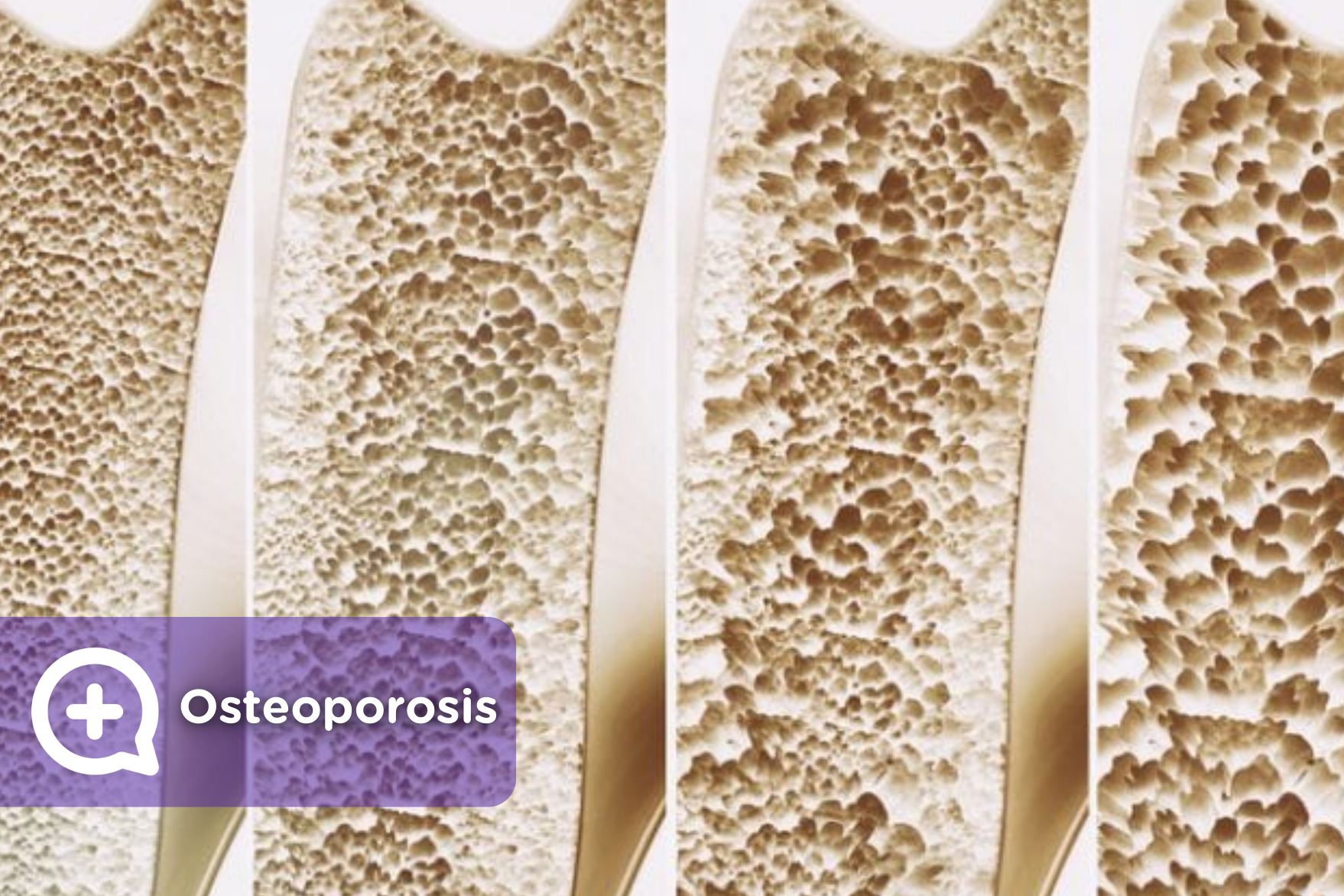 Osteoporosis Causas Y Tratamientos Mediquo