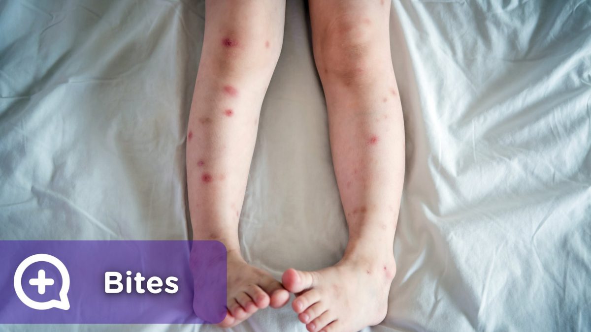 Bites and welts on legs, face, arms, body, produced by mosquitos, spiders, insects