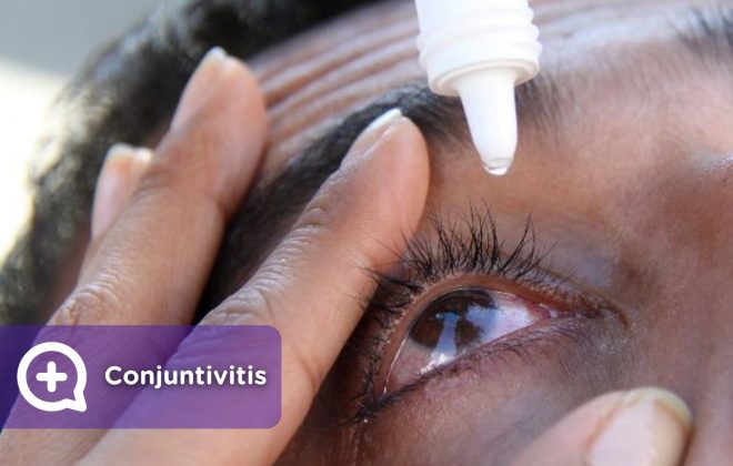 Conjuntivitis, infección en los ojos por contagio, gotas para aliviar el picor