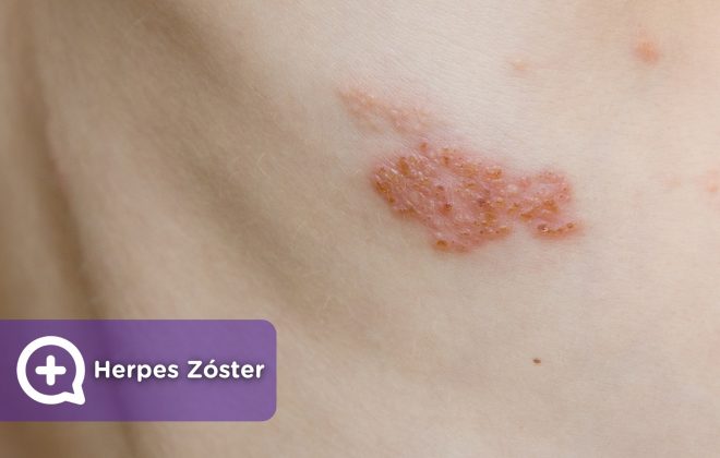 Virus Herpes Zóster, varicela, infección