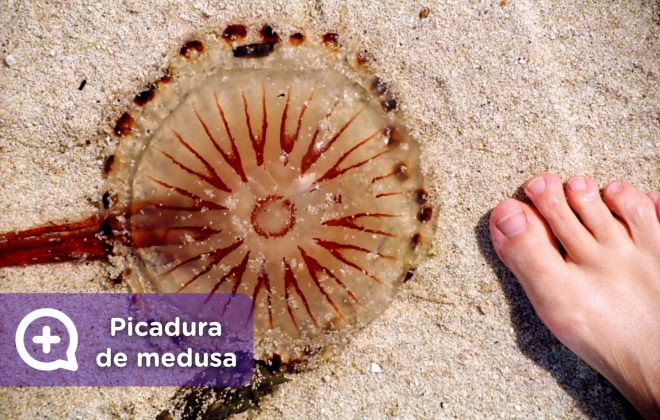 Picadura de medusa, banco de medusas en la playa venenosas, calabera portuguesa