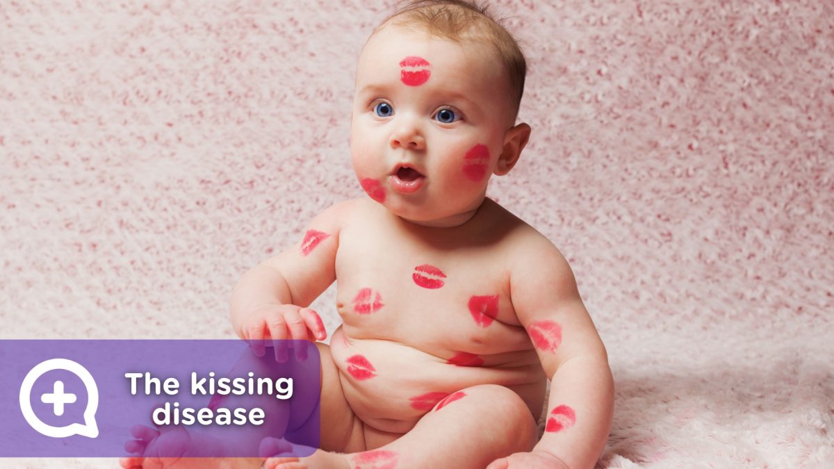 Mononucleosis or kissing disease. Infection from contact with saliva.