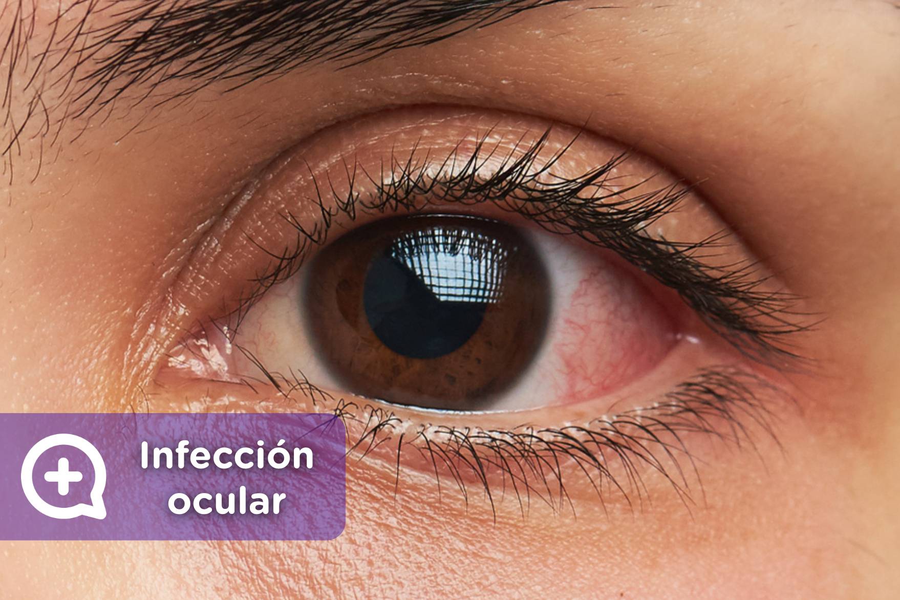 ¿tienes Infección Ocular Esto Es Lo Que Debes Hacer Mediquo 