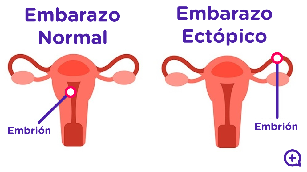 Embarazo ectópico, ¿qué es y cuál es el tratamiento? - mediQuo