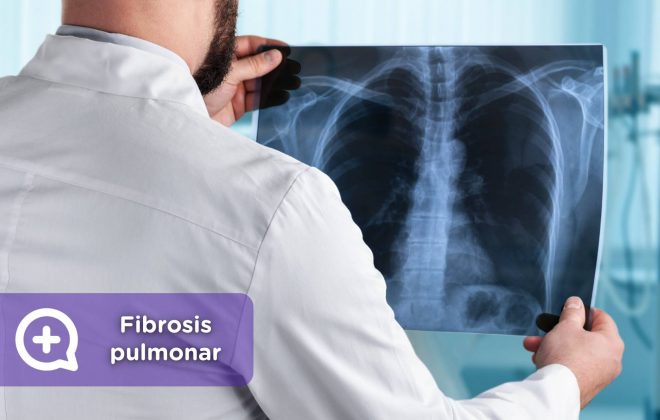 Fibrosis pulmonar, mediquo, Tu amigo médico. Radiografia, respiración. Salud.