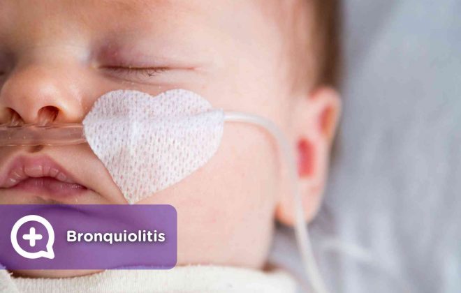 Bronquiolitis, virus, infección, vías respiratorias, pediatría, médicos, mediquo. Salud