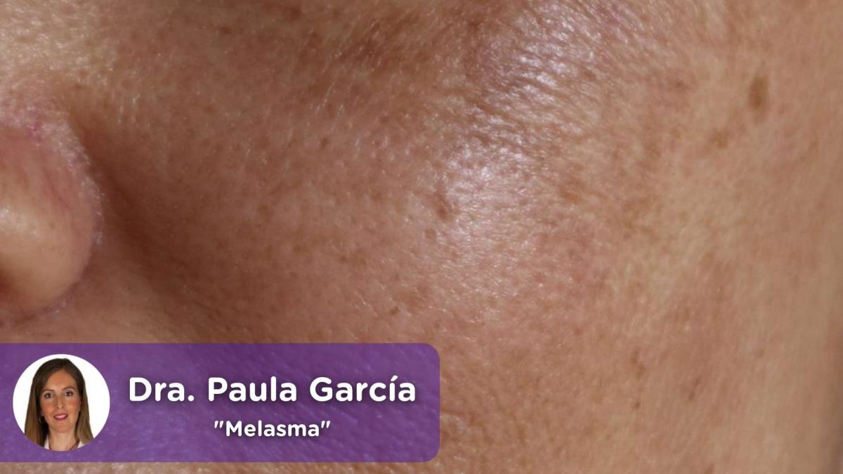 Melasma Que Es Melasma Por Que Salen Estas Manchas En La