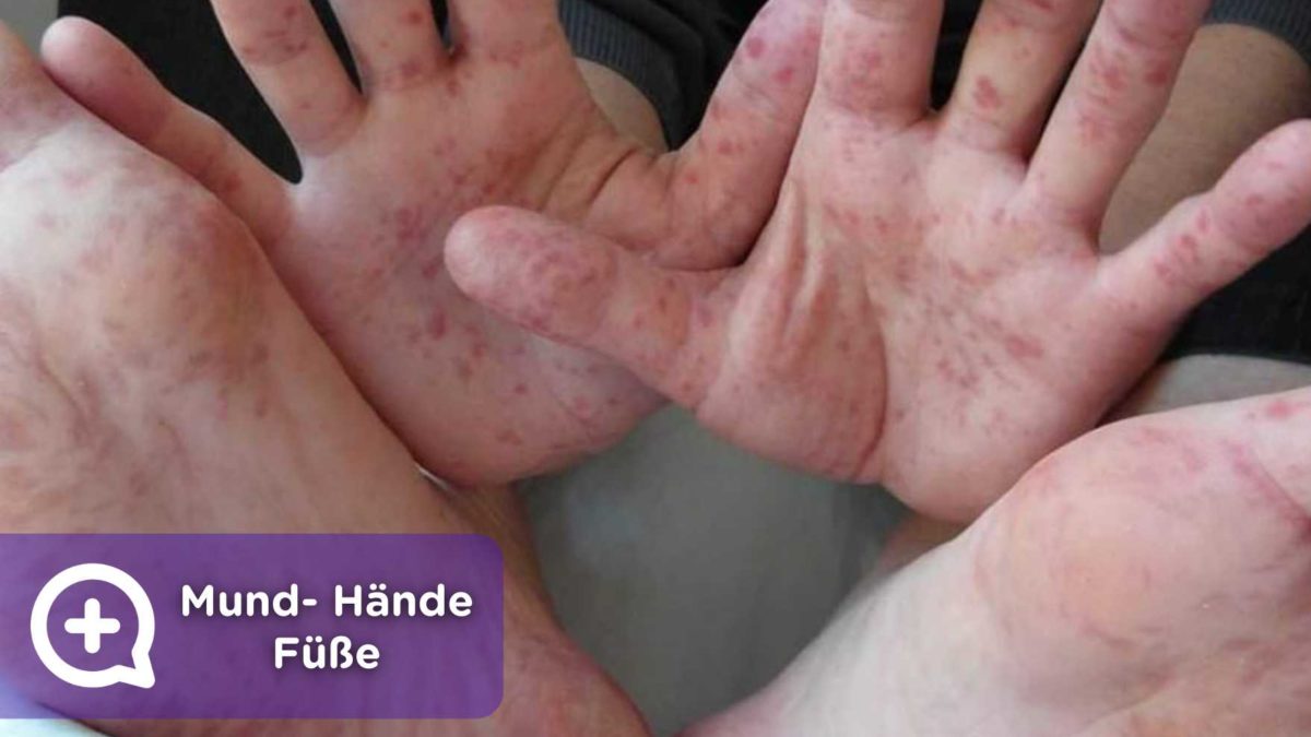 Mund Hände Füße Virus mediQuo