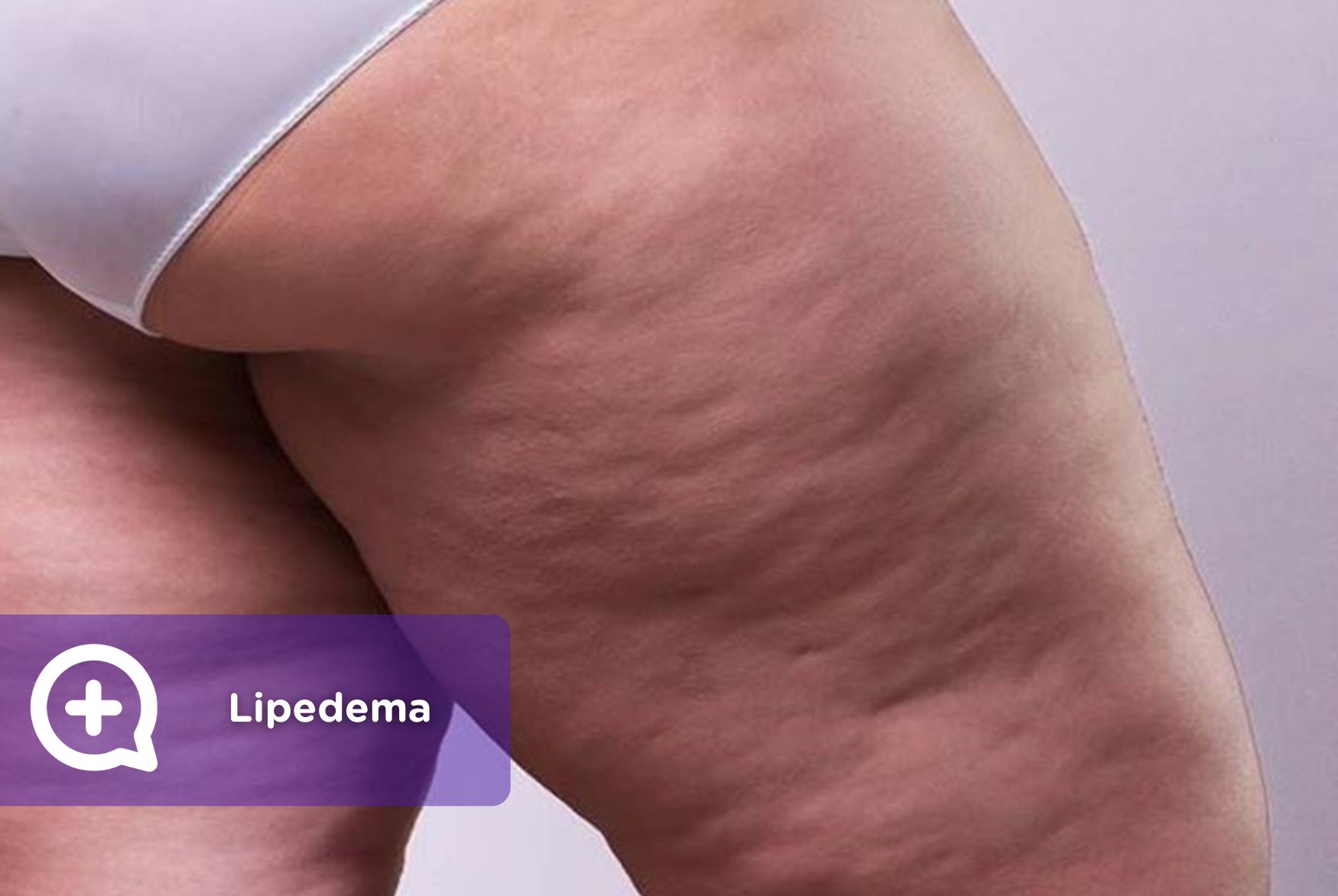 Lipedema: La enfermedad progresiva del tejido graso que debes