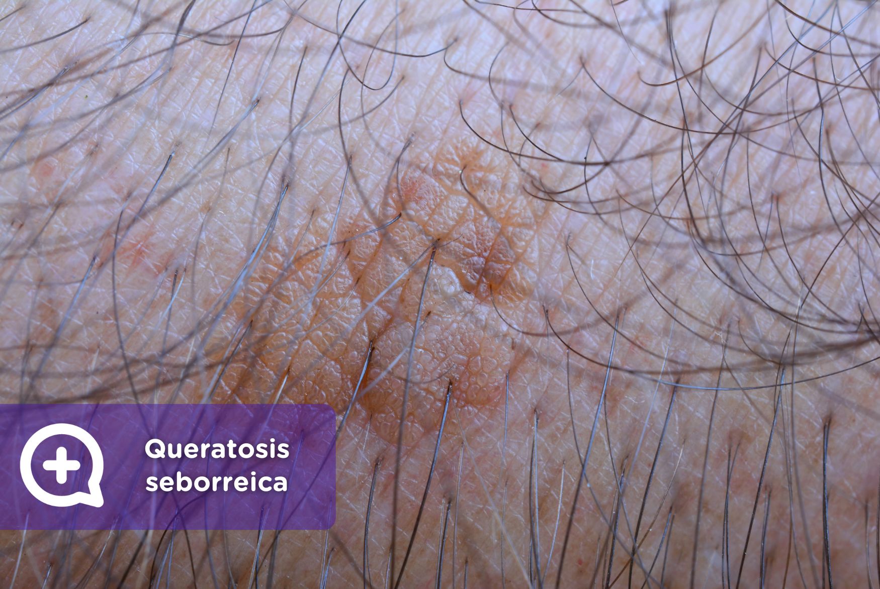 Queratosis Seborreica ¿qué Es Y Cómo Manejarla Mediquo