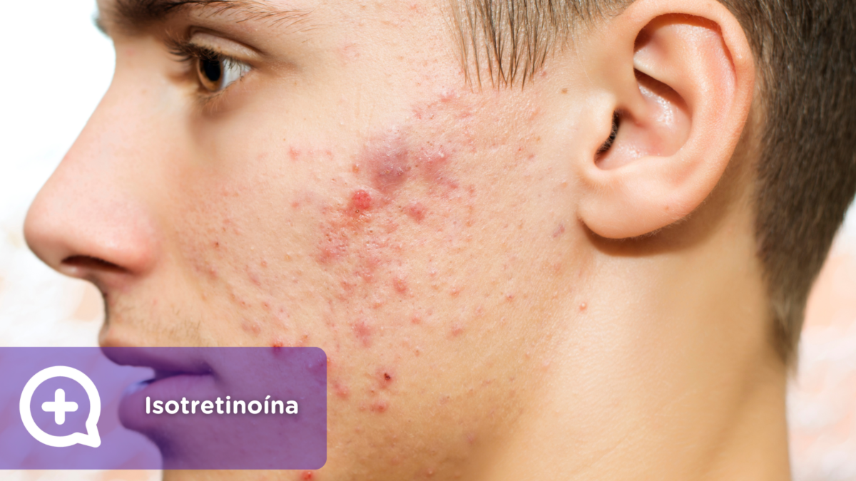 Isotretinoína. roaccutan o Roaccutane. clínica de la piel by mediquo. Tratamiento farmacológico para el acne. Receta.roaccutan o Roaccutane. clínica de la piel by mediquo. Tratamiento farmacológico para el acne. Receta.