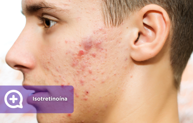 Isotretinoína. roaccutan o Roaccutane. clínica de la piel by mediquo. Tratamiento farmacológico para el acne. Receta.roaccutan o Roaccutane. clínica de la piel by mediquo. Tratamiento farmacológico para el acne. Receta.