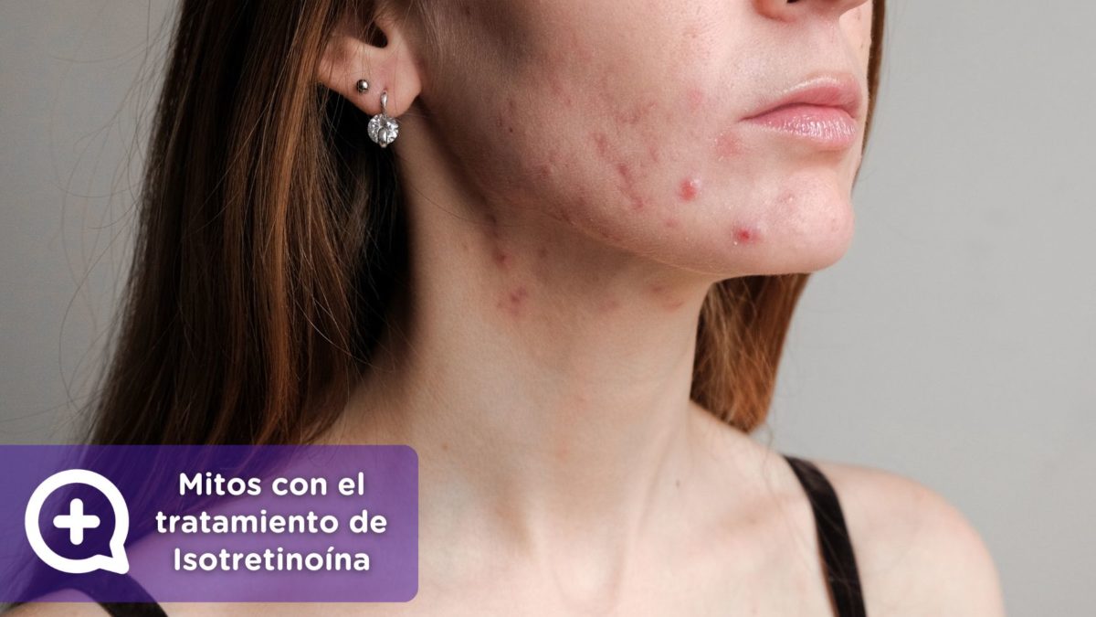 Mitos tratamiento Isotretinoína. Tratamiento para el acné severo. Isotretinoína. roaccutan o Roaccutane. clínica de la piel by mediquo. Tratamiento farmacológico para el acne. Receta.roaccutan o Roaccutane. clínica de la piel by mediquo. Tratamiento farmacológico para el acné. Receta.