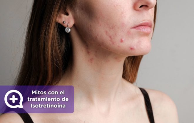 Mitos tratamiento Isotretinoína. Tratamiento para el acné severo. Isotretinoína. roaccutan o Roaccutane. clínica de la piel by mediquo. Tratamiento farmacológico para el acne. Receta.roaccutan o Roaccutane. clínica de la piel by mediquo. Tratamiento farmacológico para el acné. Receta.