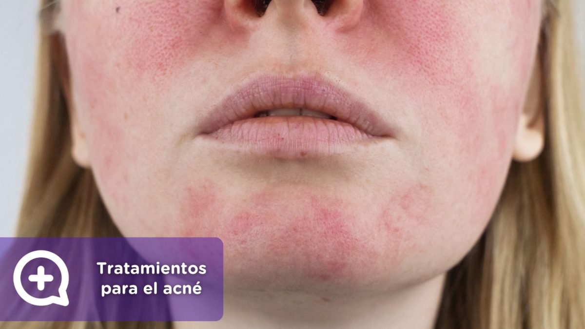 Rosácea. Tratamientos para el acné. Isotretinoína. roaccutan o Roaccutane. clínica de la piel by mediquo. Tratamiento farmacológico para el acne. Receta.roaccutan o Roaccutane. clínica de la piel by mediquo. Tratamiento farmacológico para el acne. Receta.