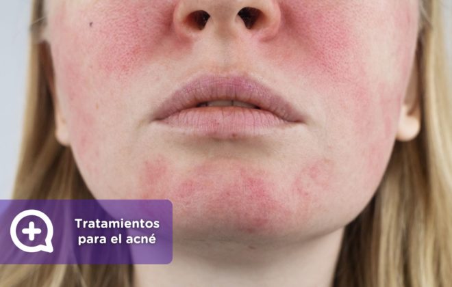 Rosácea. Tratamientos para el acné. Isotretinoína. roaccutan o Roaccutane. clínica de la piel by mediquo. Tratamiento farmacológico para el acne. Receta.roaccutan o Roaccutane. clínica de la piel by mediquo. Tratamiento farmacológico para el acne. Receta.