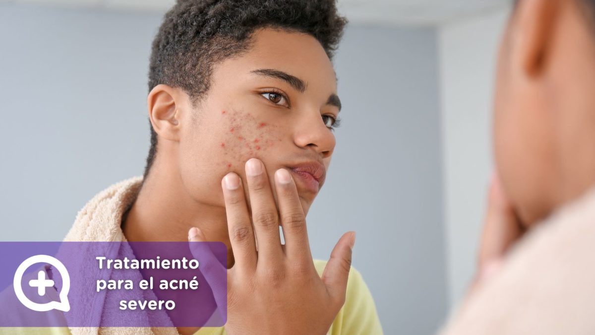 Tratamiento para el acné severo. Isotretinoína. roaccutan o Roaccutane. clínica de la piel by mediquo. Tratamiento farmacológico para el acne. Receta.roaccutan o Roaccutane. clínica de la piel by mediquo. Tratamiento farmacológico para el acne. Receta.