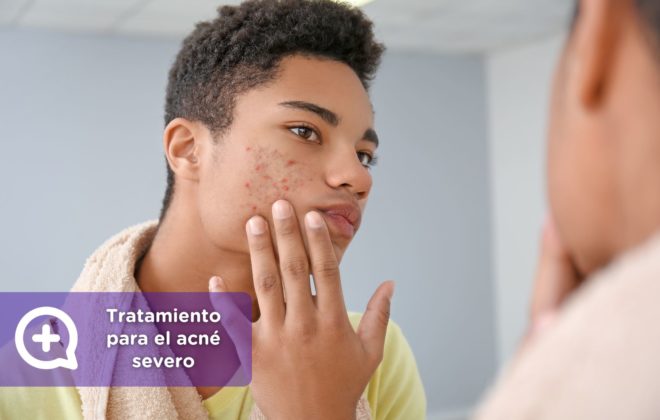 Tratamiento para el acné severo. Isotretinoína. roaccutan o Roaccutane. clínica de la piel by mediquo. Tratamiento farmacológico para el acne. Receta.roaccutan o Roaccutane. clínica de la piel by mediquo. Tratamiento farmacológico para el acne. Receta.